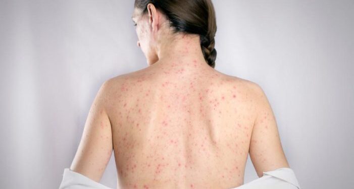 According to Researchers From Germany and the United States, Getting the Shot Increases the Risk of Shingles