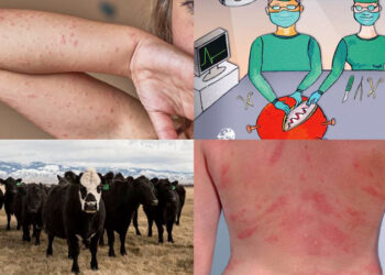 Bombshell! COVID Vaccines Contain Cow Protein That Triggers Deadly Meat Allergies