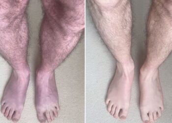 Long COVID: Unusual case turns man's legs blue after 10 minutes of standing up