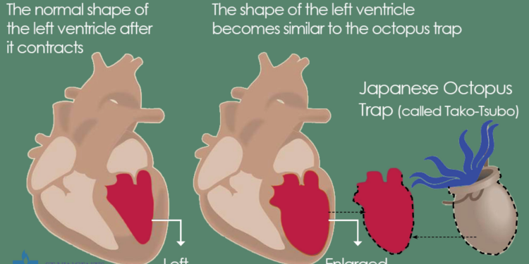 Takotsubo Cardiomyopathy: Potential Trigger by COVID-19 Vaccines – A Research Study