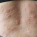 ICAN Disputes FDA’s Attempt to Reduce Clinical Trial Requirements for Vaccine Approval