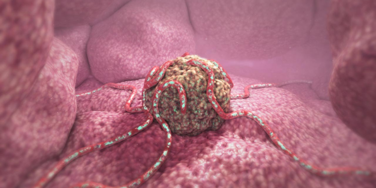 Preprint Discovers Unusual Surge in Excess Neoplasm Death Rates Among Young Individuals